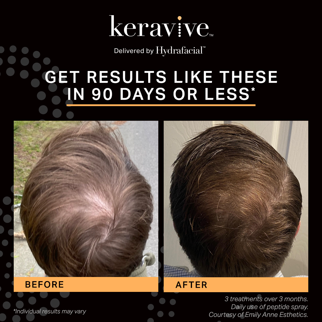 HydraFacial Keravive treatment results for fuller, healthier hair