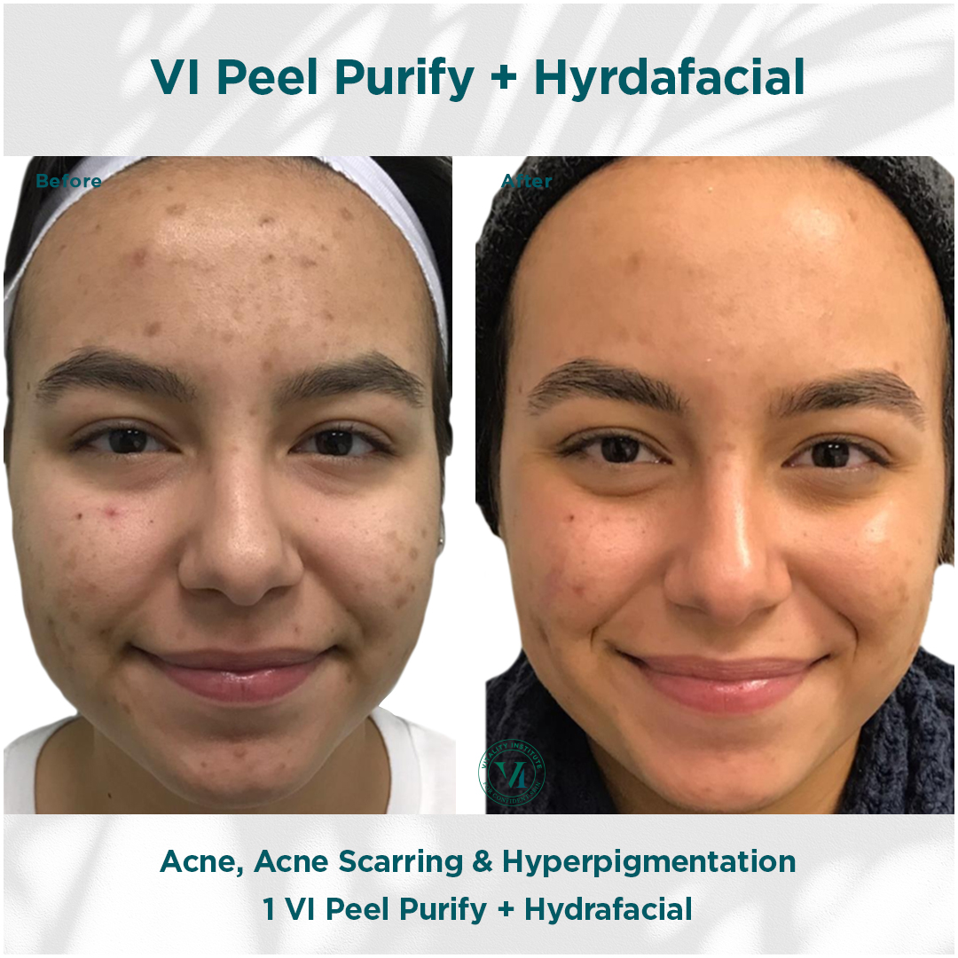 Before and after: acne, scarring and hyperpigmentation treatment results