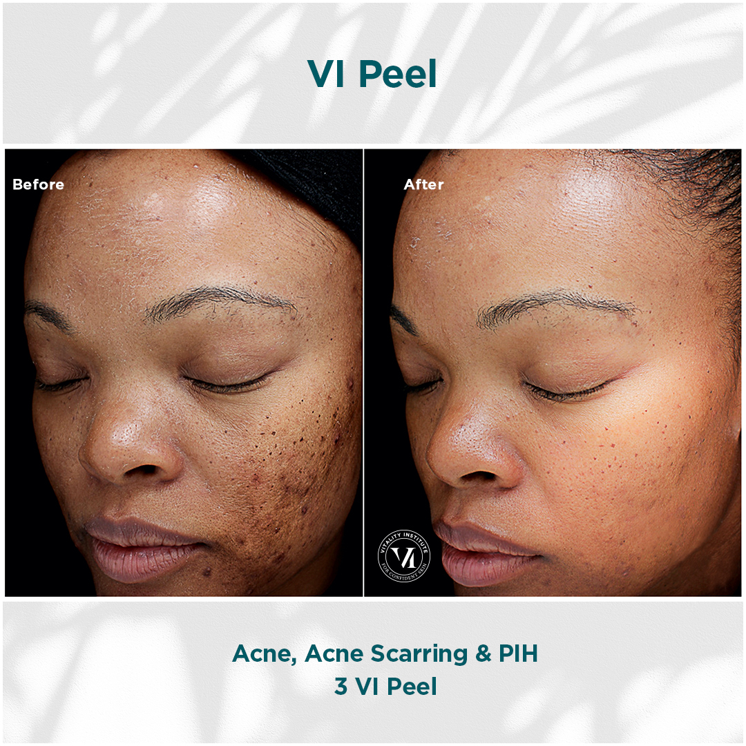 Before and after: acne, scarring and post-inflammatory hyperpigmentation results