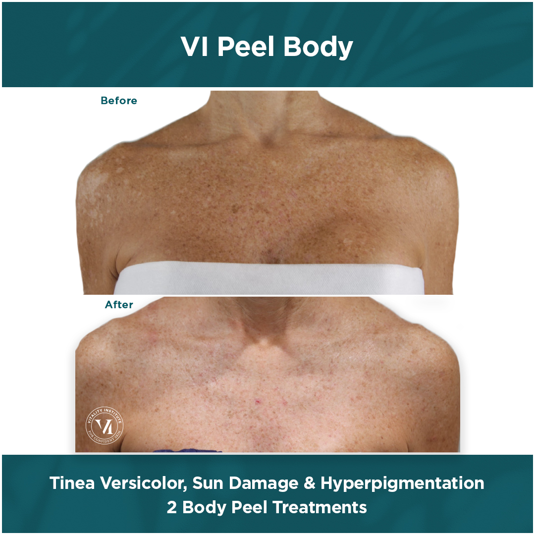Before and after: body peel and tinea versicolor treatment results
