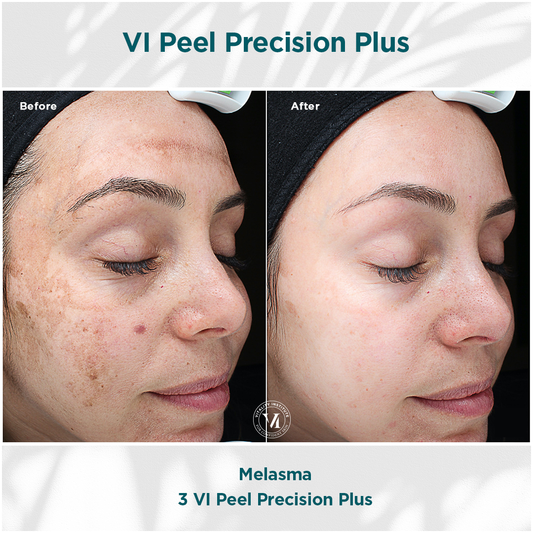 Before and after: melasma treatment results