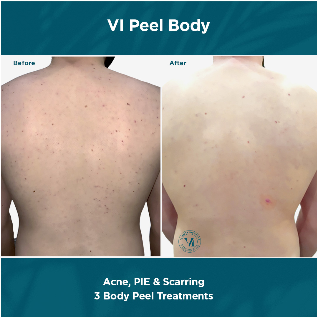 Before and after: peel and glow treatment results
