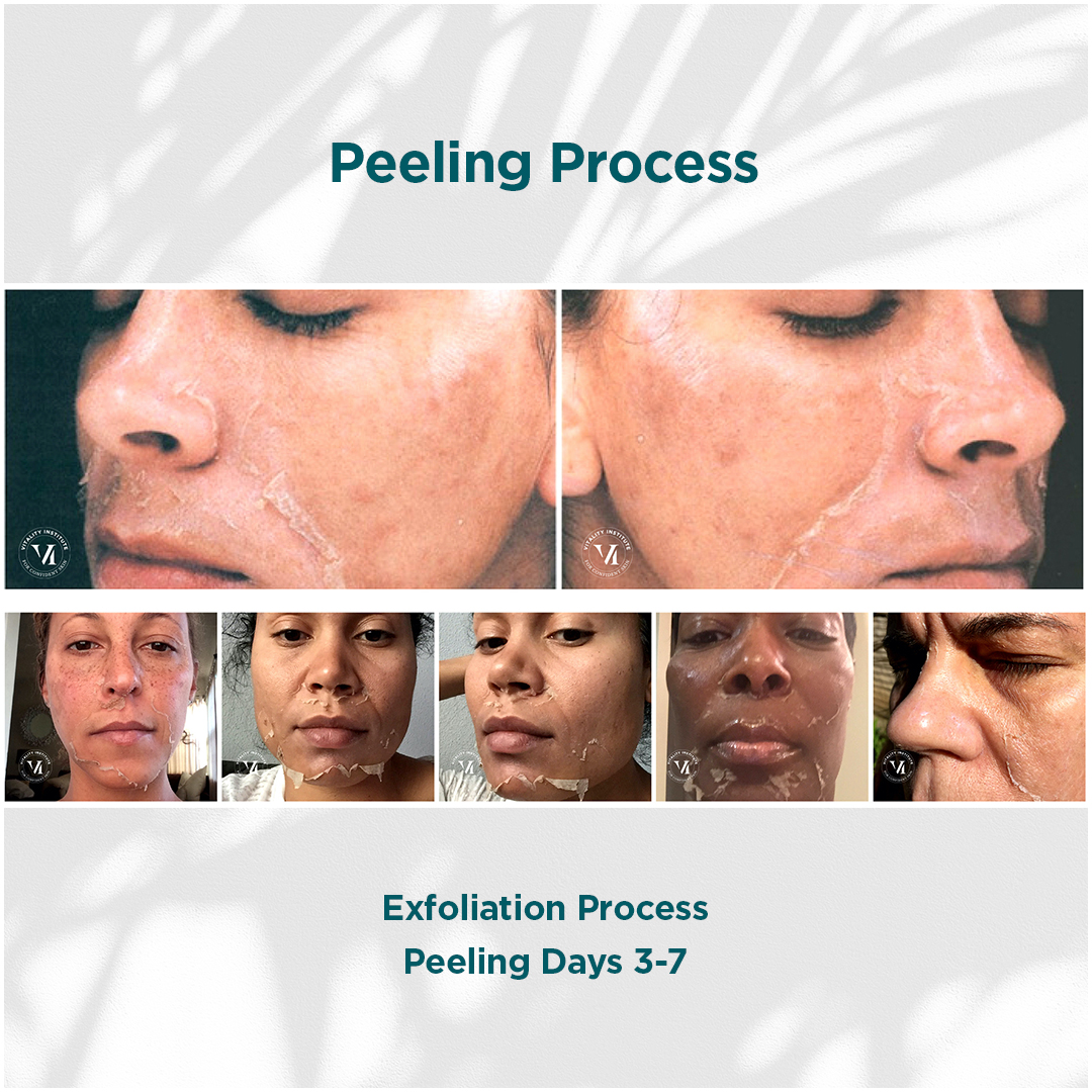 Before and after: chemical peel renewal results