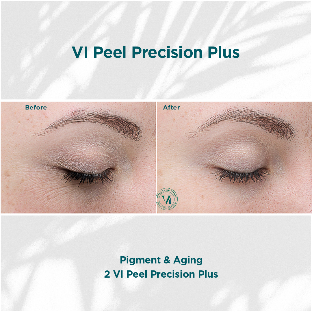 Before and after: pigmentation and aging skin treatment results