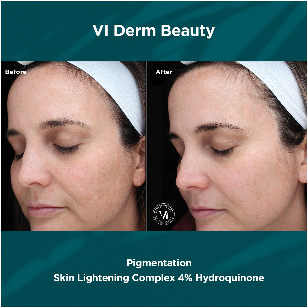 Before and after: pigmentation treatment results
