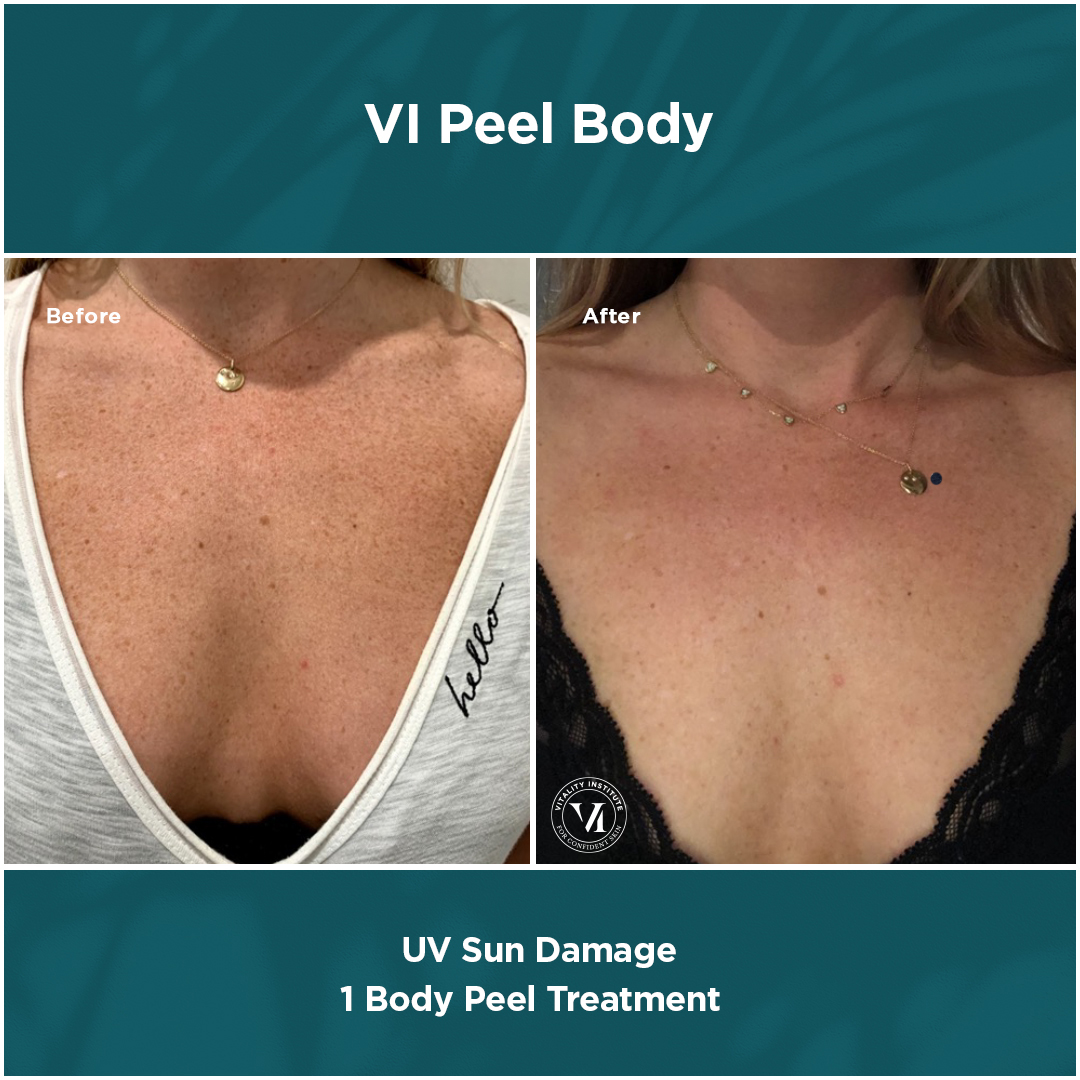 Before and after: UV and sun damage skin treatment results